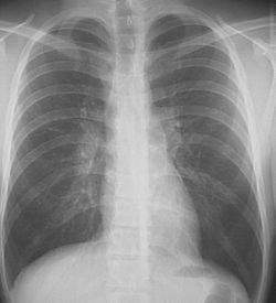 imagine cu cancerul pulmonar